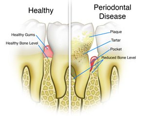 Healthy Teeth vs Periodontal Disease