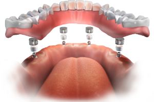 Implant Retained Denture