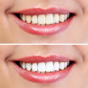 Teeth Whitening Results: Before & After