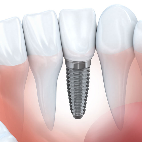 Dental Implants